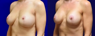 Left 3/4 View - Breast Implant Revision with Galaflex