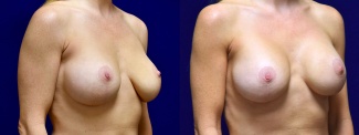 Right 3/4 View - Breast Implant Revision with Galaflex