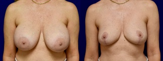 Frontal View - Breast Implant Removal