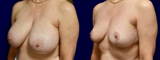 Left 3/4 View - Breast Implant Removal