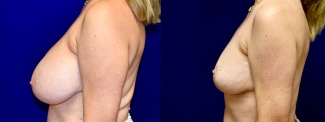 Left Profile View - Breast Implant Removal