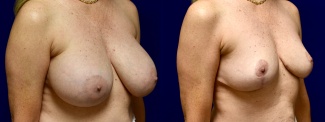 Right 3/4 View - Breast Implant Removal