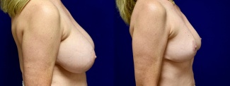 Right Profile View - Breast Implant Removal