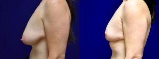 Left Profile View - Breast Reduction