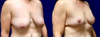 Right 3/4 View - Breast Reduction