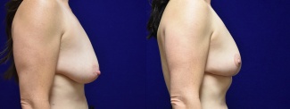Right Profile View - Breast Reduction