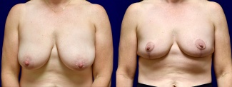 Frontal View - Breast Reduction