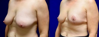 Left 3/4 View - Breast Reduction