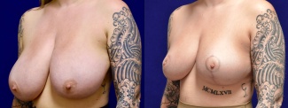 Left 3/4 View - Breast Reduction