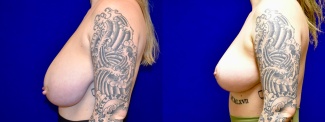 Left Profile View - Breast Reduction