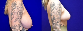 Right Profile View - Breast Reduction