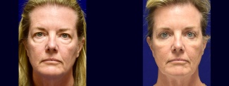 Frontal View - Upper & Lower Eyelid Surgery