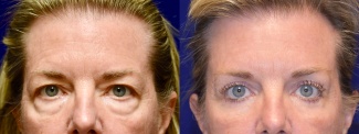Frontal View - Upper & Lower Eyelid Surgery