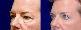 Left 3/4 View - Upper & Lower Eyelid Surgery