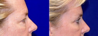 Right Profile View - Upper & Lower Eyelid Surgery