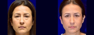 Frontal View - Upper & Lower Eyelid Surgery