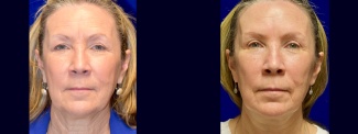 Frontal View - Browlift with Upper Eyelid Surgery
