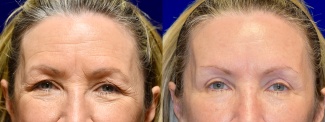Frontal View - Browlift with Upper Eyelid Surgery