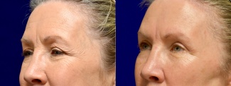 Left 3/4 View - Browlift with Upper Eyelid Surgery