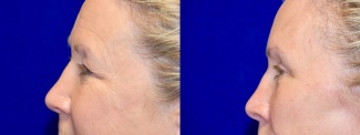 Left Profile View - Browlift with Upper Eyelid Surgery