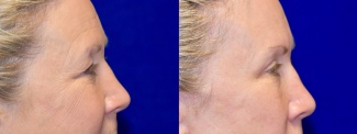 Right Profile View - Browlift with Upper Eyelid Surgery