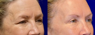 Right 3/4 View - Browlift with Upper Eyelid Surgery