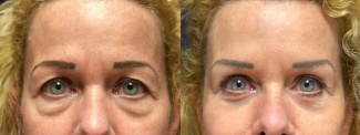 Frontal View - Eyelid Surgery