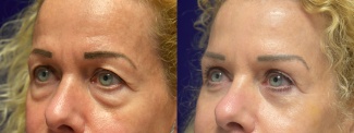 Left 3/4 View - Eyelid Surgery