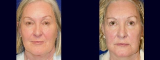 Frontal View - Facelift with Eyelid Surgery