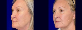 Left 3/4 View - Facelift with Eyelid Surgery