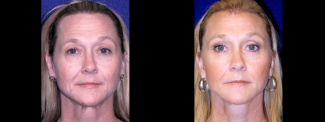 Frontal View - Lower Facelift, Brow Lift and Upper Eyelid Surgery