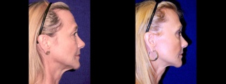 Right Profile View - Lower Facelift, Brow Lift and Upper Eyelid Surgery