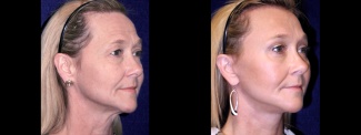 Right 3/4 View - Lower Facelift, Brow Lift and Upper Eyelid Surgery