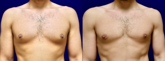 Frontal View - Male Breast Reduction with Peripheral Liposuction