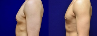 Left Profile View - Male Breast Reduction with Peripheral Liposuction