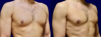 Right 3/4 View - Male Breast Reduction with Peripheral Liposuction