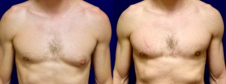 Frontal View - Male Breast Reduction