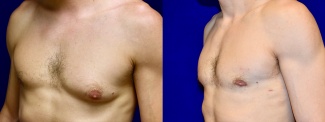 Left 3/4 View - Male Breast Reduction