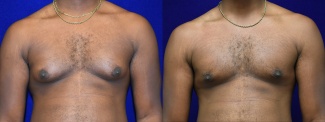 Frontal View - Male Breast Reduction