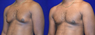 Left 3/4 View - Male Breast Reduction