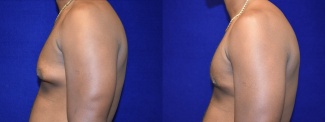 Left Profile View - Male Breast Reduction