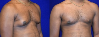 Right 3/4 View - Male Breast Reduction