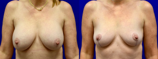 Frontal View - Breast Implant Removal and Breast Lift