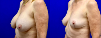 Left 3/4 View - Breast Implant Removal and Breast Lift