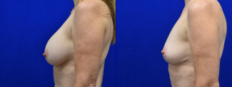 Left Profile View - Breast Implant Removal and Breast Lift