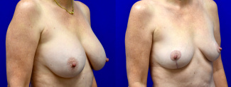 Right 3/4 View - Breast Implant Removal and Breast Lift