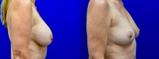 Right Profile View - Breast Implant Removal and Breast Lift