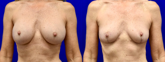 Frontal View - Breast Implant Removal and Breast Lift