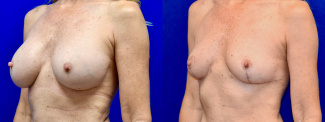 Left 3/4 View - Breast Implant Removal and Breast Lift