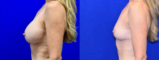 Left Profile View - Breast Implant Removal and Breast Lift